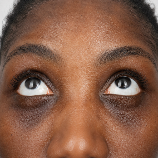 Finones undereye before and after