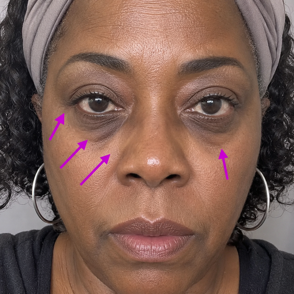 Finones undereye before and after