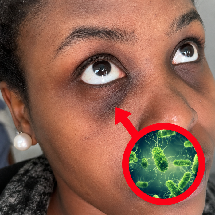 Close-up of dark circles/undereye area showing skin vitamin deficiency