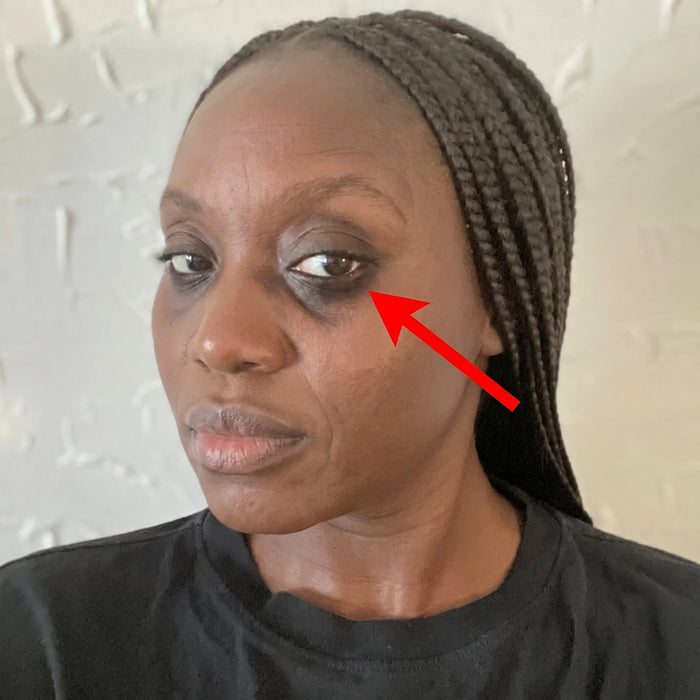Dark spot treatment